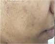 WhiteGlow Freckle Cream photo review