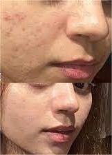 WhiteGlow Freckle Cream photo review